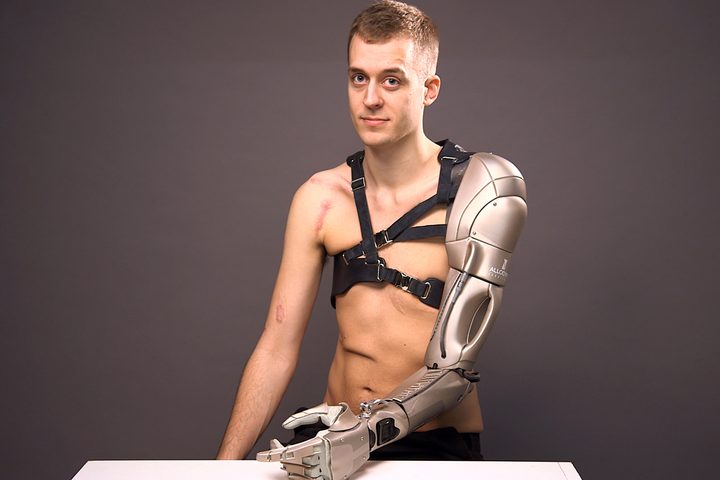 Prosthetic-Arm-0002