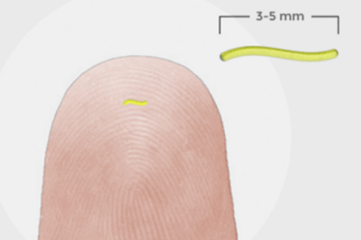 Profusa implantable biosensor