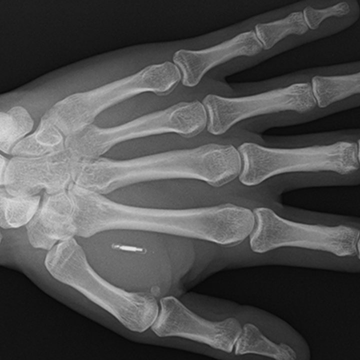 workplace microchipping next gen id company chip feat 3