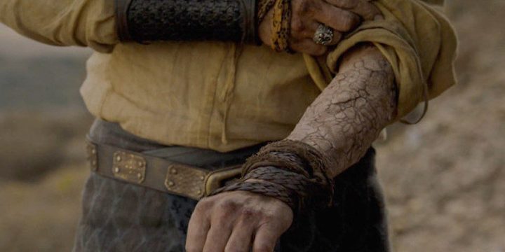Jorah Mormont infected with Greyscale