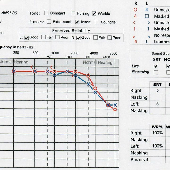 An audiologist-performed audiogram.