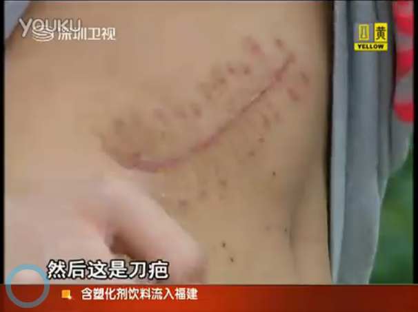 zheng scar