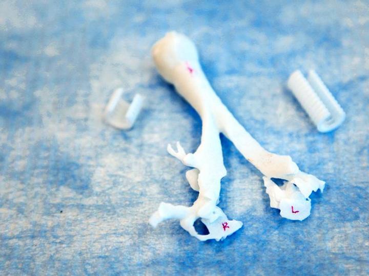 3d printed splint helped save babys life