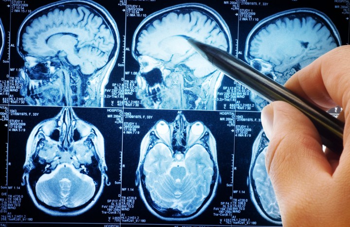 parkinsons disease brain cells reprogrammed scan