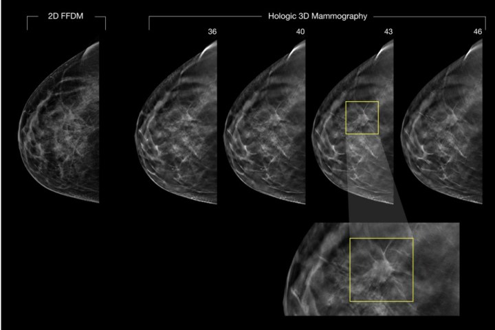 3D mammography (tomosynthesis) images