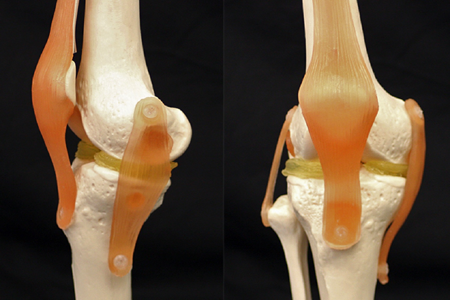 3d printed cartilage knee implant