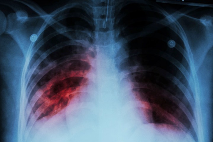 bioengineering donor lungs 40063323 l
